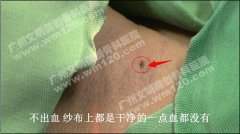 早 泄并包莖一次輕松治愈