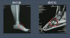 廣東龍川楊某 足舟骨缺血性壞死康復案例
